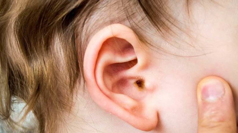 Uzmanı uyardı: Orta kulak iltihabı çocuklarda geçici işitme kaybına neden olabilir