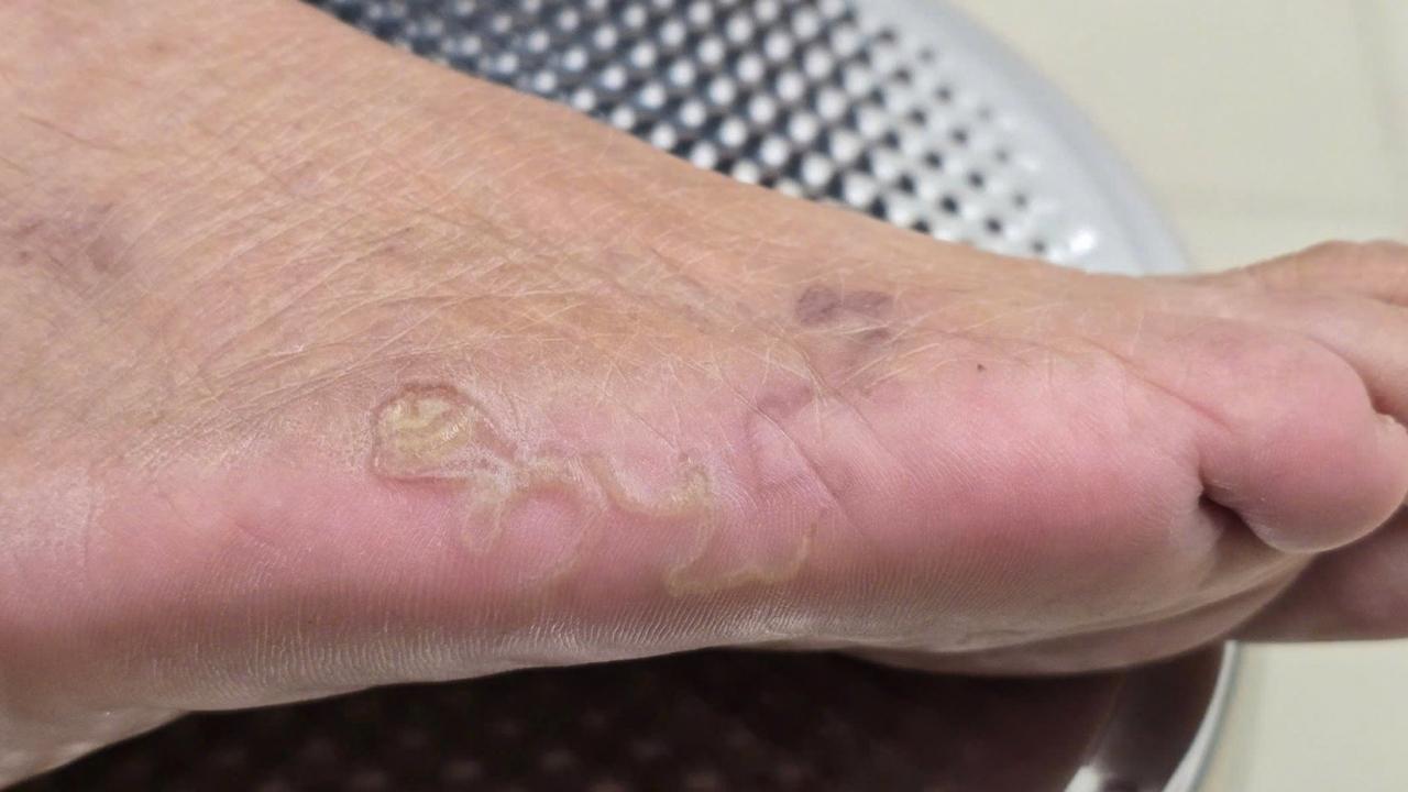 Çıplak ayak gezmek bile yasakalanmıştı: Rize’deki bu hastalık 1980’den beri görülmedi